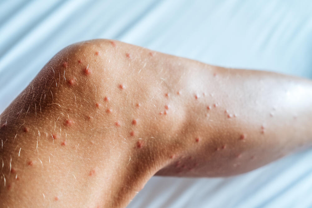 Tipos de mosquitos domésticos: conheça quais são eles Tipos de mosquitos domésticos: conheça quais são eles
